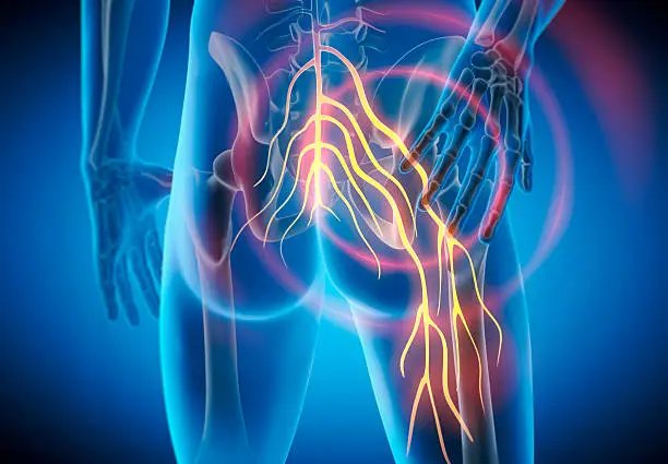 Sciatica chiropractic care Livonia MI